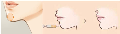 贝丽姿隆下巴效果哪里好