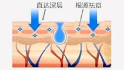 祛痘治疗1.jpg