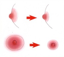 乳晕缩小
