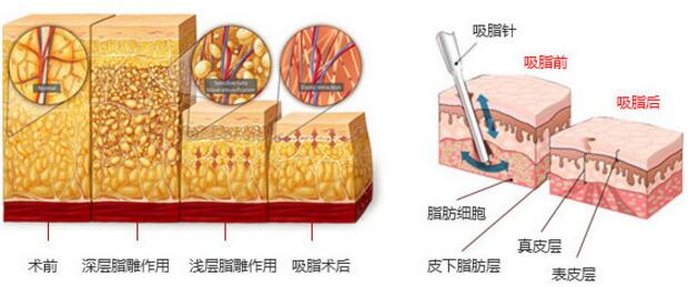 游泳圈可以通过吸脂去除吗?