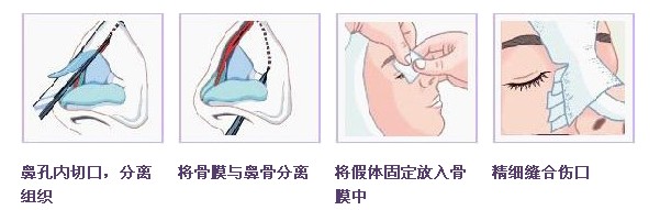 南京哪里的隆鼻技术好?