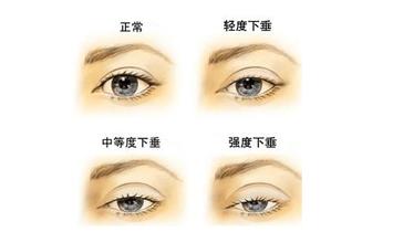 南京做上睑下垂矫正技术哪家好?