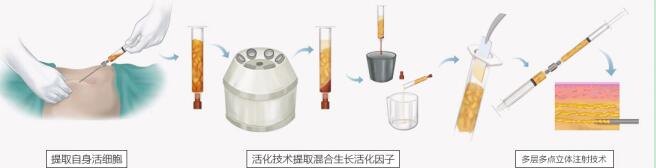 南京自体丰胸会留下后遗症吗?