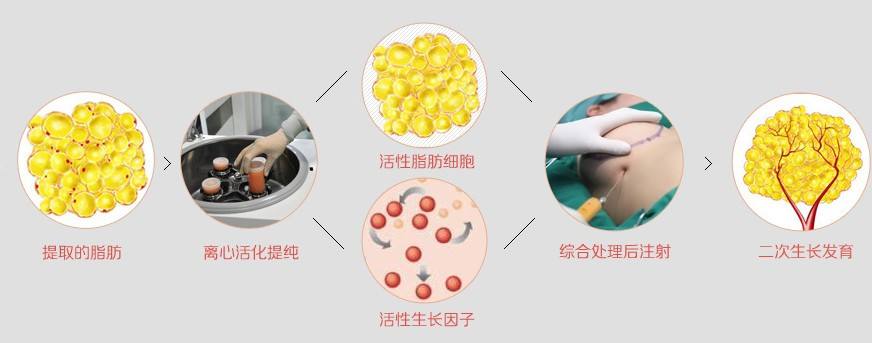 南京自体丰胸会留下后遗症吗?