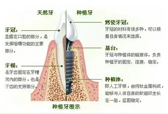 做种植牙手术会痛苦吗?