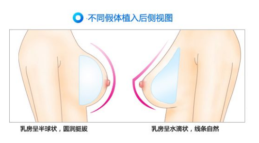 假体丰胸