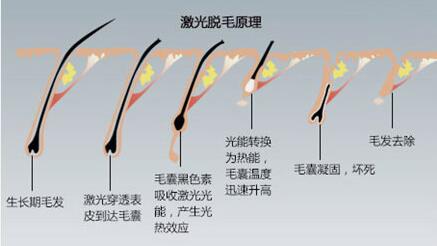 激光脱毛在美容院做安全吗?
